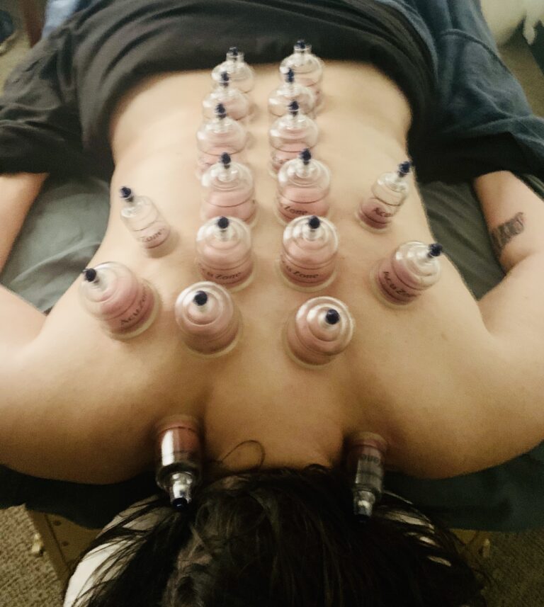 Cupping Therapy